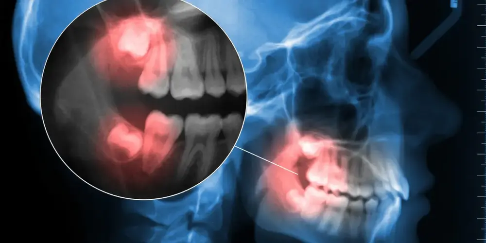 Dente siso pode causar dor na coluna